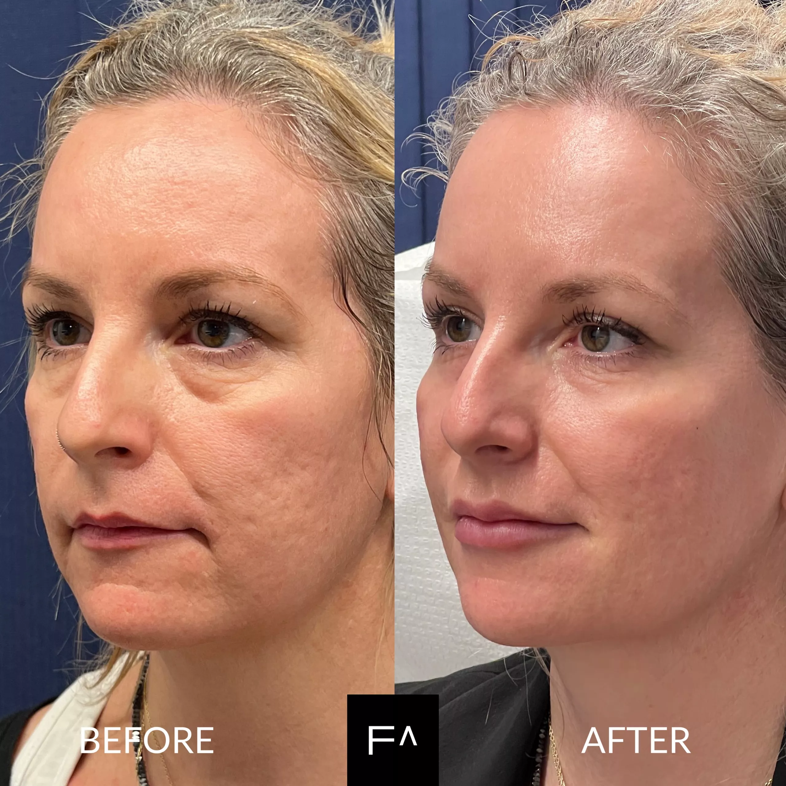 Hyaluronic Acid Get Rid of Expression Wrinkles Permanently